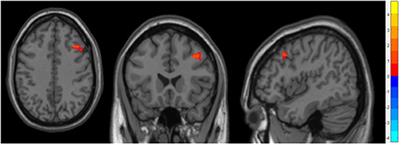 Alterations of brain gray matter volume in children with obstructive sleep apnea